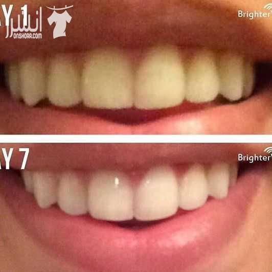 ❤️جهاز تبييض الاسنان المنزلى بالليزر❤️ سعروو 13 دينار والتوصيل مجاني 0780036355 تخلص من آثار التدخين والقهوه نهائيا خلال اسبوع بس