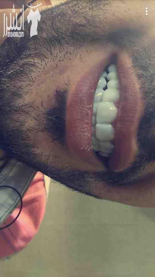 ????Snap On Smile ???? فـقـط فـي جلـستين ???????? احصلو على ابتسامة المشاهير (ابتسامة هوليوود) ???????????????? قشور رقيقة و قوية تغطي العيوب الموجوده بالاسنان الحل الامثل لتظهر بإبتسامة خاليه من...