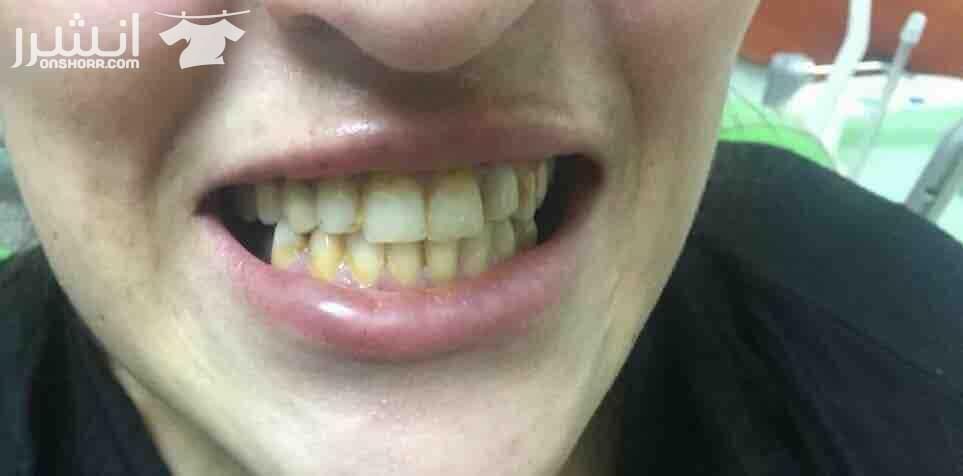 ????Snap On Smile ???? فـقـط فـي جلـستين ???????? احصلو على ابتسامة المشاهير (ابتسامة هوليوود) ???????????????? قشور رقيقة و قوية تغطي العيوب الموجوده بالاسنان الحل الامثل لتظهر بإبتسامة خاليه من...