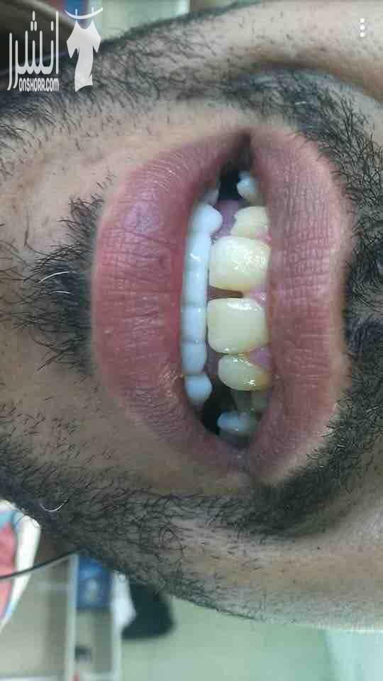 ????Snap On Smile ???? فـقـط فـي جلـستين ???????? احصلو على ابتسامة المشاهير (ابتسامة هوليوود) ???????????????? قشور رقيقة و قوية تغطي العيوب الموجوده بالاسنان الحل الامثل لتظهر بإبتسامة خاليه من...