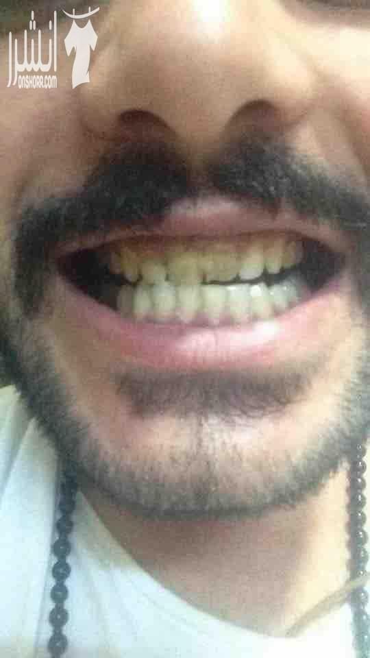 ????Snap On Smile ???? فـقـط فـي جلـستين ???????? احصلو على ابتسامة المشاهير (ابتسامة هوليوود) ???????????????? قشور رقيقة و قوية تغطي العيوب الموجوده بالاسنان الحل الامثل لتظهر بإبتسامة خاليه من...