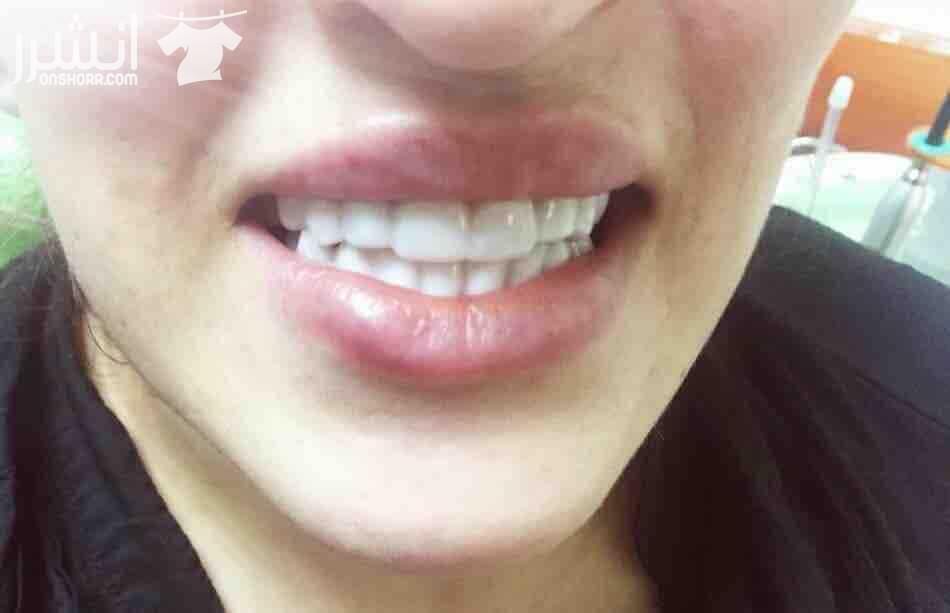 ????Snap On Smile ???? فـقـط فـي جلـستين ???????? احصلو على ابتسامة المشاهير (ابتسامة هوليوود) ???????????????? قشور رقيقة و قوية تغطي العيوب الموجوده بالاسنان الحل الامثل لتظهر بإبتسامة خاليه من...
