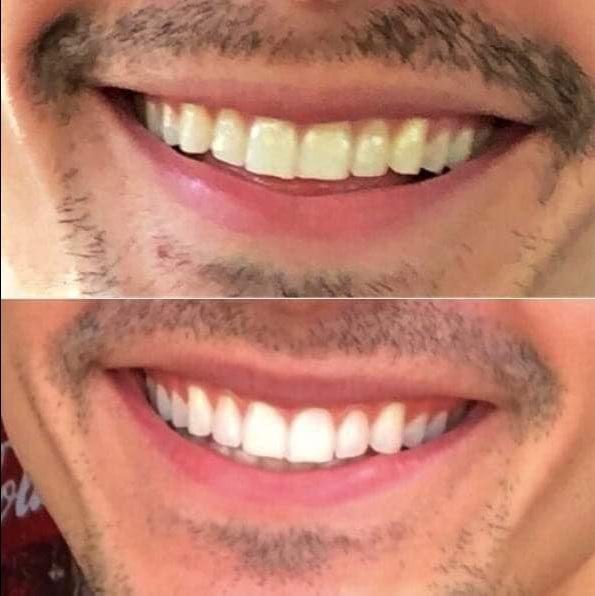 عرروووض 10 دنانير شامل التوصيل ❌❌❌
قلم تبييض الأسنان +جهاز تبييض الأسنان بالليزر??
0780036355 للطلب والاستفسار واتساب ??
يحتوي على :
قلم تبييض الأسنان ?
جهاز تبييض الأسنان بتقنية
?LED
مسحات لل...
