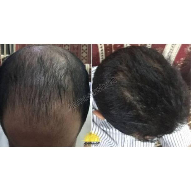 #عالجي_شعرك_خلال_شهر_بنتائج_مكفووووله ?? للطلب والاستفسار واتساب 0780036355
#زيت_سالتوس_للشعر_والرموش_والحواجب_واللحيه ?
#عندك_تساقط_وقشره_وفراغات_في_شعرك ??
#شعرك_تالف_متقصف_وفي_فراغات ??
?? بطو...