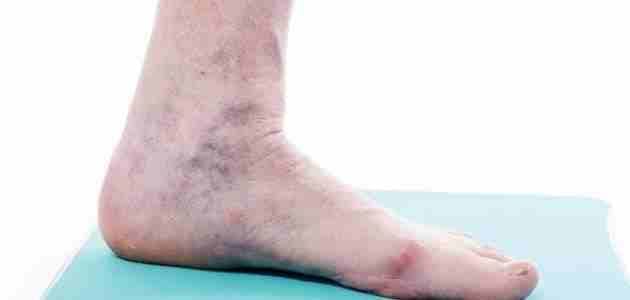 جوارب الدوالي
لا تنسَ أنك شاهدت هذا الإعلان في عنكبوت
#جوارب_طبية_لعلاج_الدوالي
#السعر_12دينار___...
