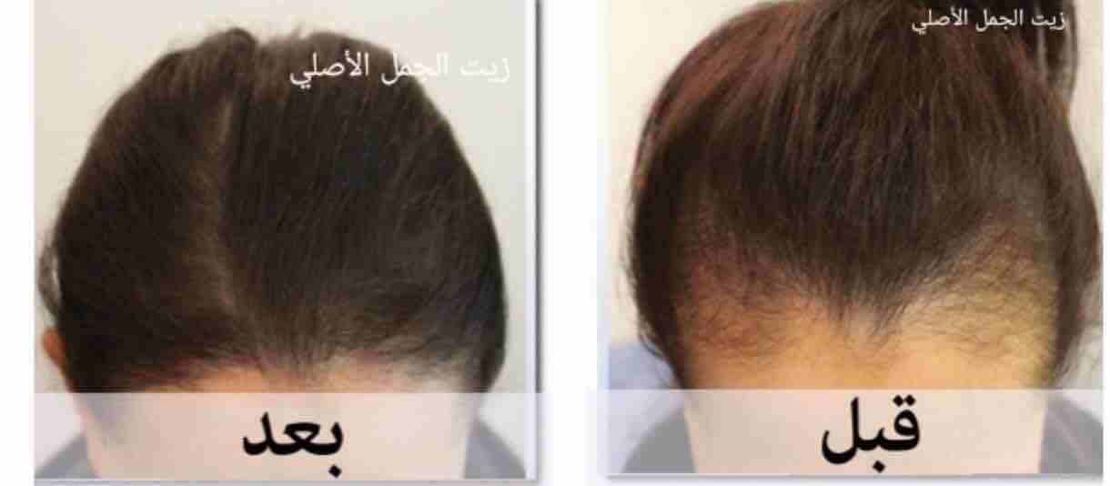 شعرك بكت ؟🙄
عندك فراغات كبيرة بشعرك ؟😔
عندك مشكلة بأنبات الشعر ؟🤔
الحل موجوووود 🤗😍ومضمون 100%🤩
زيت الجمل
☘️يعالج مشكلة تساقط الشعر التي يعاني منها الكثيرين نساء كانو او رجال ويقوي البصيلات ويع...