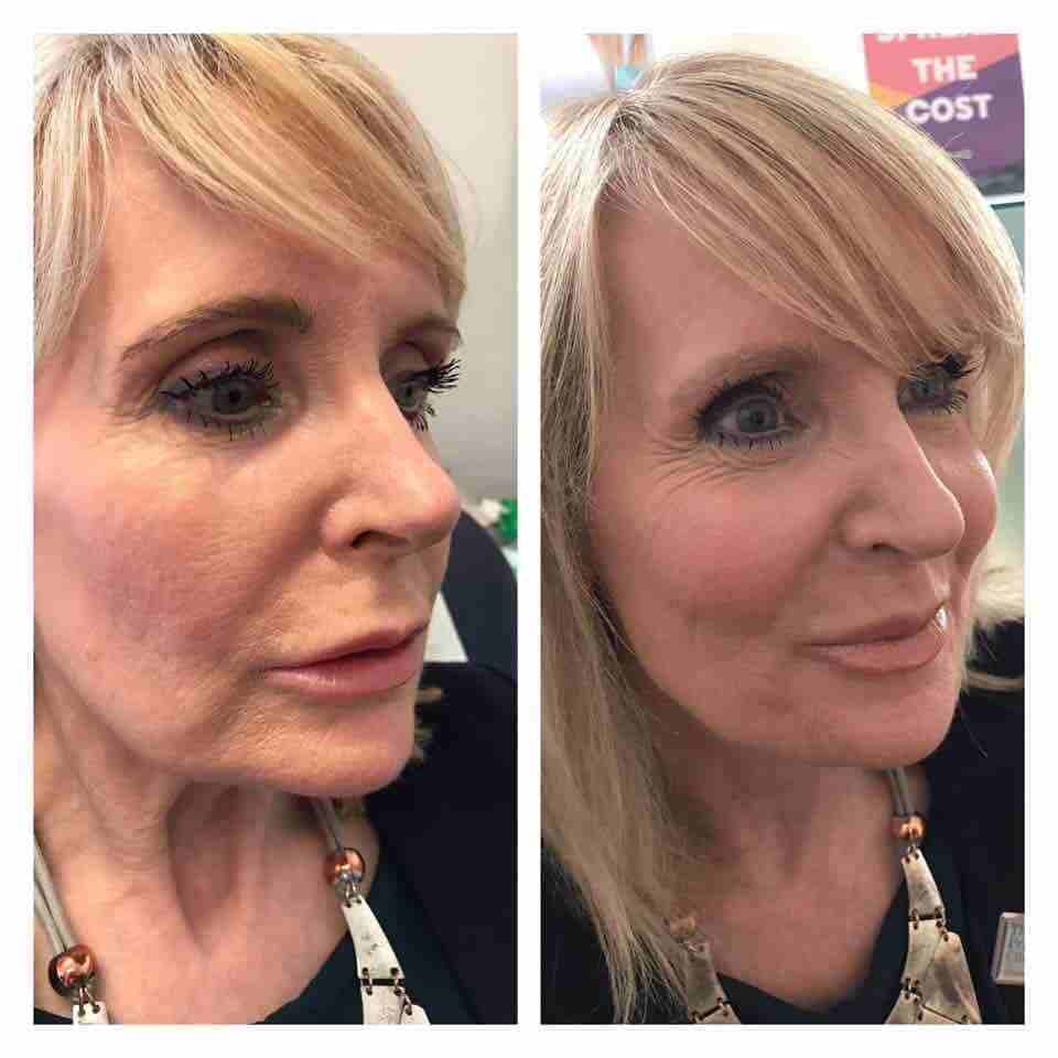 🎗كريم التسمين الطبيعي 🎗
نصاحة الوجه بتبين كل ملامحه 💁‍♀
اكتر وحدة كنت أعااااني من نحافة الوجه 🙋‍♀
بلشت استخدمه وبلشت أستفيد حتى صرت ام خدووود
لازم احكيلكم عن جماله وفوائده وروعته الي مو طب...
