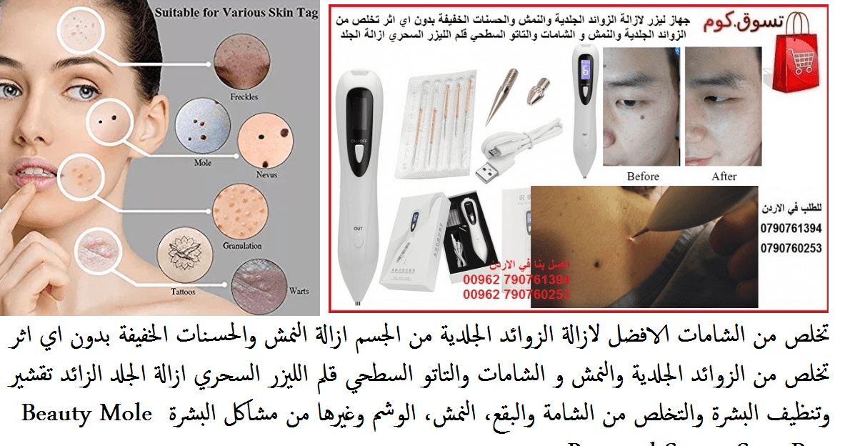 الافضل لازالة الزوائد الجلدية من الجسم ازالة النمش والحسنات الخفيفة بدون اي اثر تخلص من الزوائد الجلدية