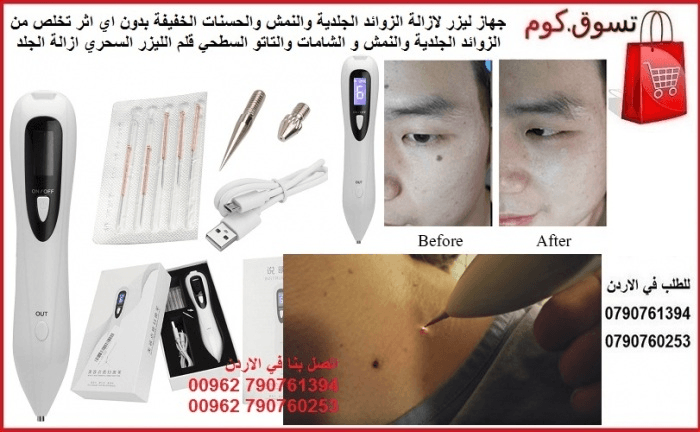 الافضل لازالة الزوائد الجلدية من الجسم ازالة النمش والحسنات الخفيفة بدون اي اثر تخلص من الزوائد الجلدية