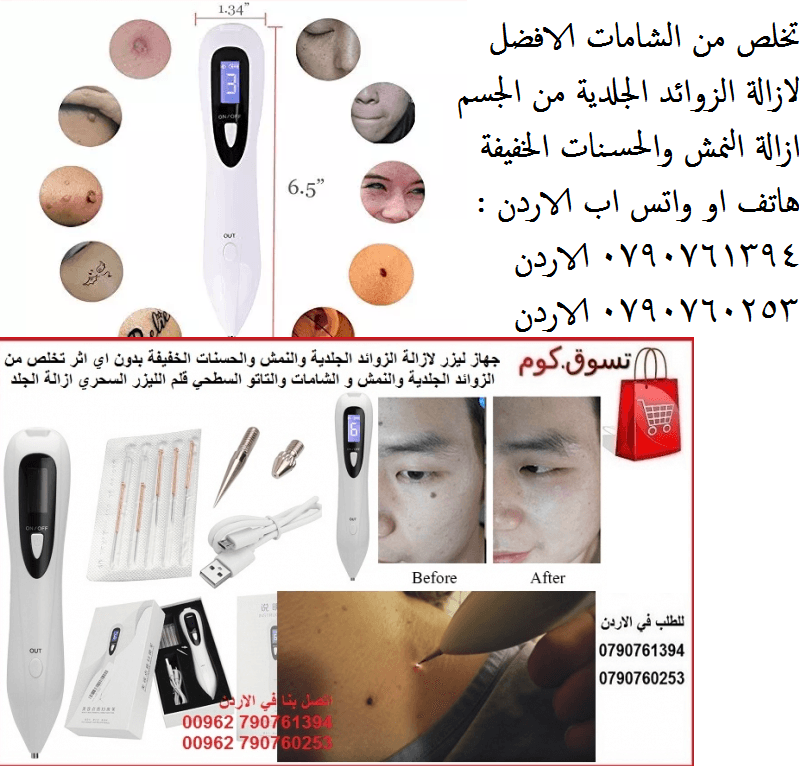 الافضل لازالة الزوائد الجلدية من الجسم ازالة النمش والحسنات الخفيفة بدون اي اثر تخلص من الزوائد الجلدية