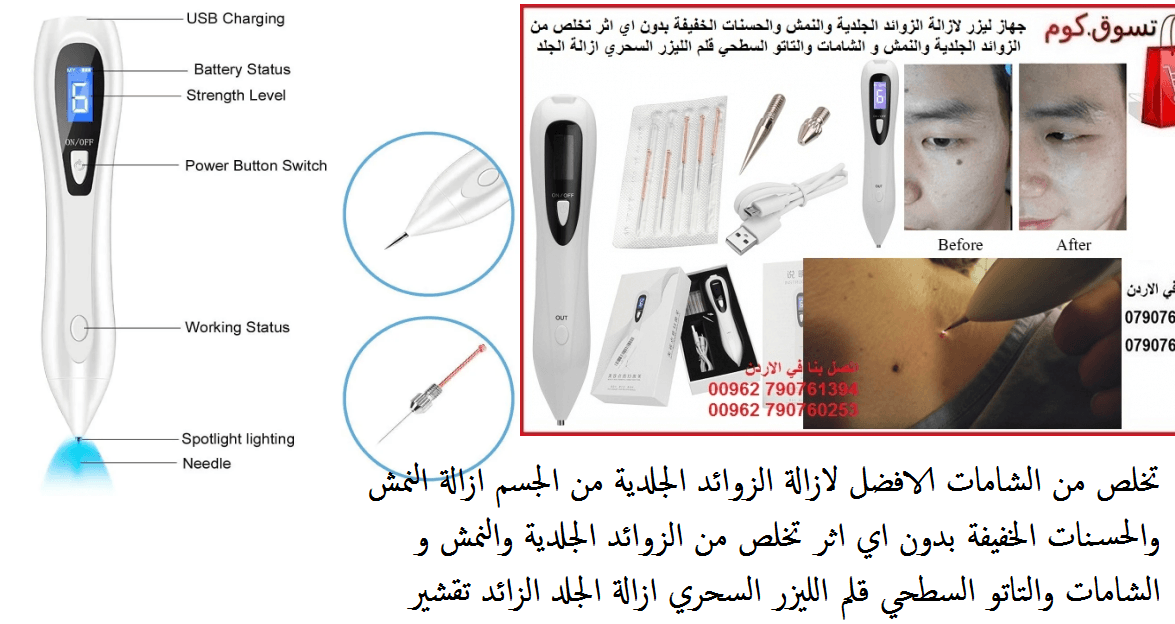 الافضل لازالة الزوائد الجلدية من الجسم ازالة النمش والحسنات الخفيفة بدون اي اثر تخلص من الزوائد الجلدية