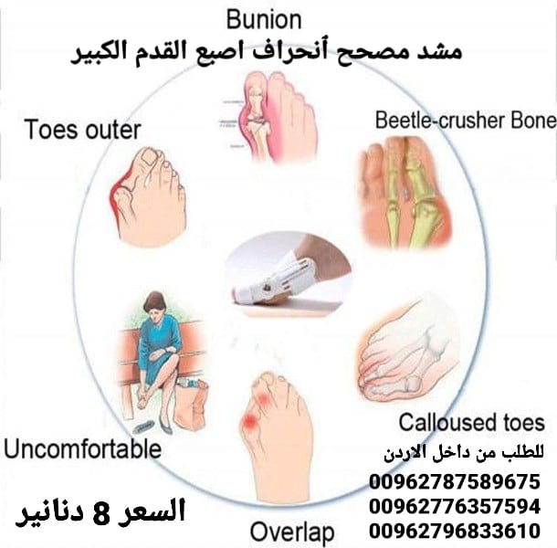 علاج بروز إبهام القدم بدون جراحة جهاز تقويم اصبع القدم الكبير .